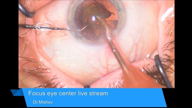 Lentis MF20 with upper placement of near segment Lukan Mishev Live Stream