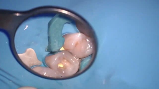 Лечение пульпита (удаление нерва)