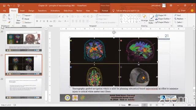 Diskusi Ilmiah Neuro-Onkologi