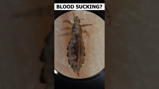 Human head Louse under microscope video |Head Lice under microscope view | Pediculus humanus capiti
