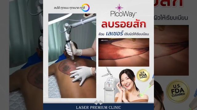ลบรอยสักสีแดงด้วย picoway laser ที่เลเซอร์พรีเมียมคลินิกภูเก็ต #picoway #picolaser #tattoo removal