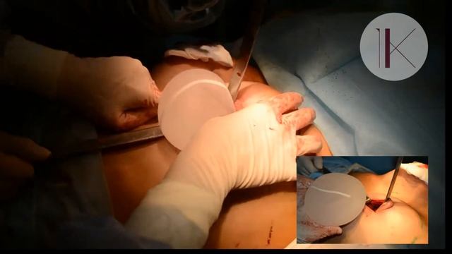 Моя история увеличения груди. Фото до после. Константинова Ирина Валерьевна