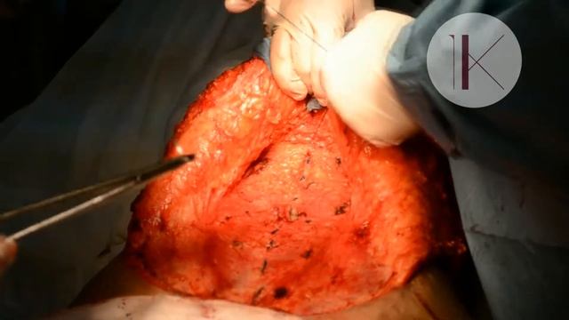 Абдоминопластика. Пластика живота. Пластический хирург Константинова Ирина Валерьевна