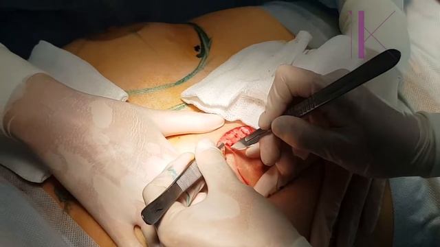 Подтяжка груди по ореоле с увеличением. Пластический хирург Константинова Ирина Валерьевна