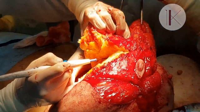 Редукция (уменьшение груди ) Константинова Ирина Валерьевна