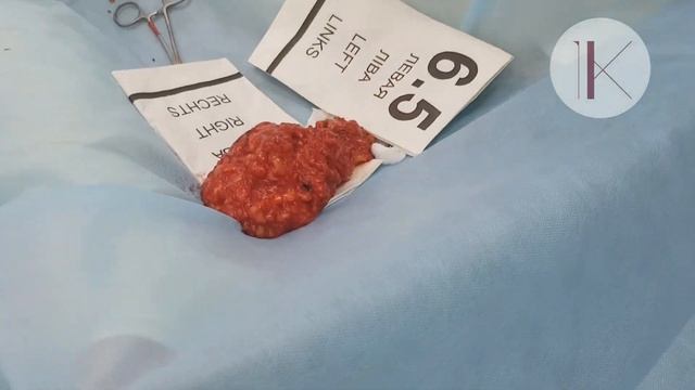 Редукционная маммопластика (уменьшение груди) Хирург Константинова Ирина Валерьевна.