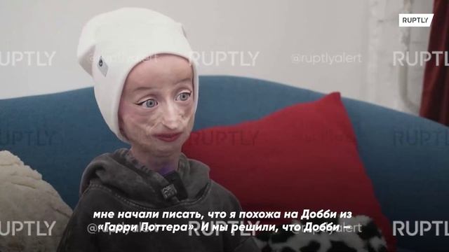 Русская «Добби»: стремительно стареющая из-за болезни 14-летняя девочка