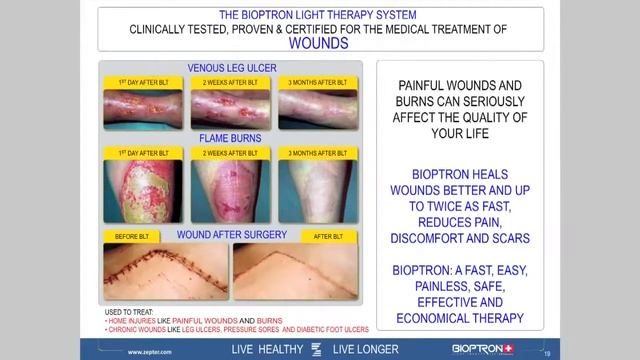 Benefits of Bioptron® Light Therapy System - Your Wellness Empowered