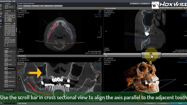 Virtual Implant Treatment Plan Simulation