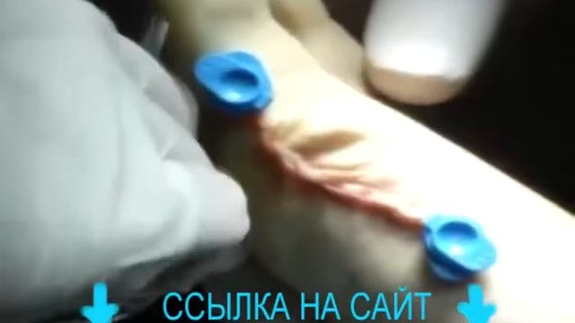 вальгусный бандаж ночной