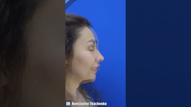 ЭНДОСКОПИЧЕСКАЯ ПОДТЯЖКА ЛБА И РИНОПЛАСТИКА 

12 дней после операции 

#подтяжкалица