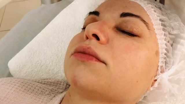 Удаление сосудистых звездочек лазером