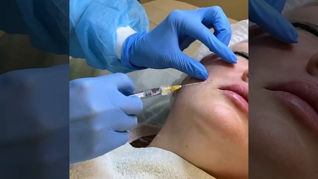 Коррекция носогубных складок в косметологии Face&Body