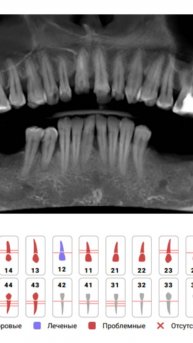 #Shorts Спасите наши ЗУБЫ !!!!#ЗУБЫ#ЛЕЧЕНИЕ зубов#кариес#