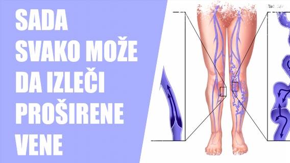 Liječenje proširenih vena magnetom 🎯 Liječenje proširenih vena na nogama cijena ⚫