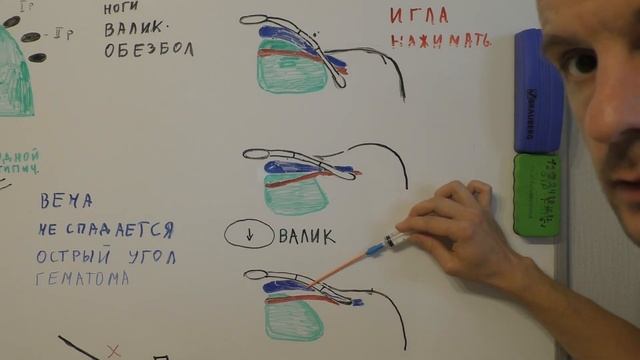 Катетеризация подключичной вены по анатомическим ориентирам (vena subclavia).