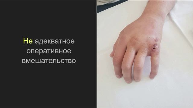 Травма кисти от удара о зубы