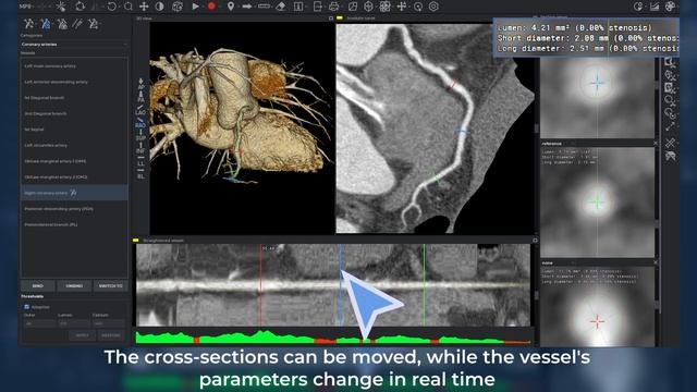 Дополнительный модуль анализа коронарных артерий в Inobitec DICOM Viewer Pro