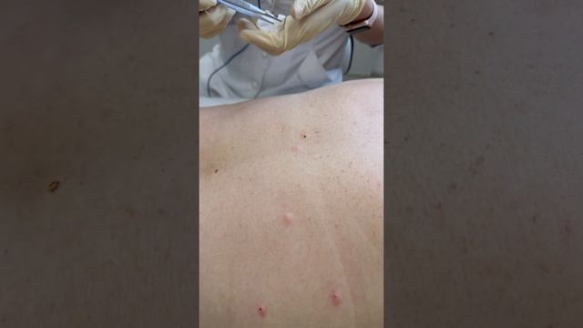 Удаление новообразований