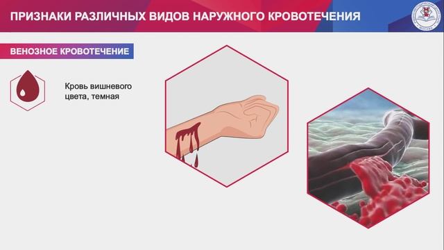 Тема 3. Вопрос 2. Признаки различных видов кровотечения