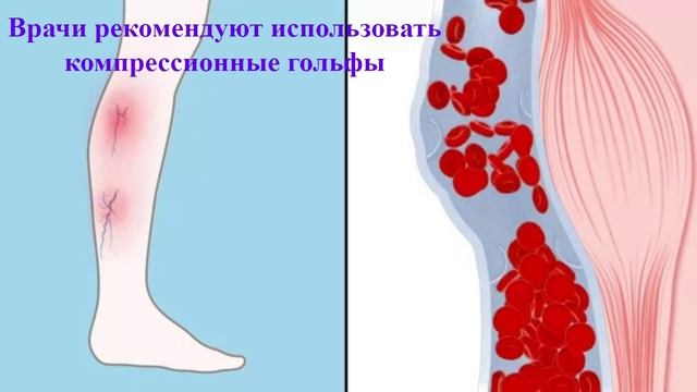 Работа вен при варикозном расширении