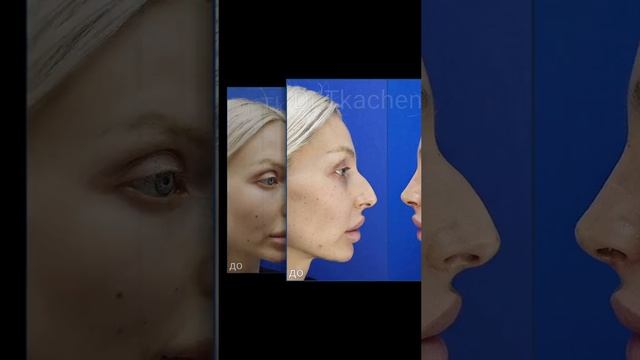 Эндоскопическая подтяжка лба и ринопластика.