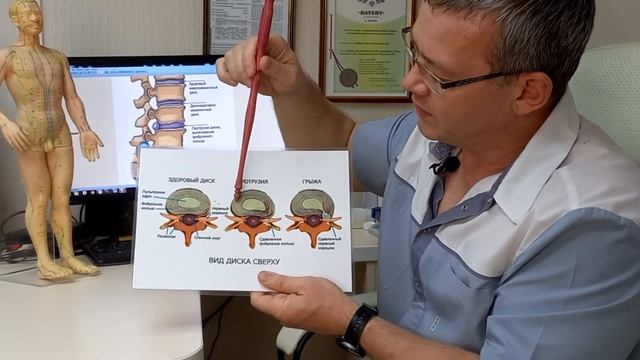 ♂️ Боль в пояснице, протрузии, грыжи: как лечить?