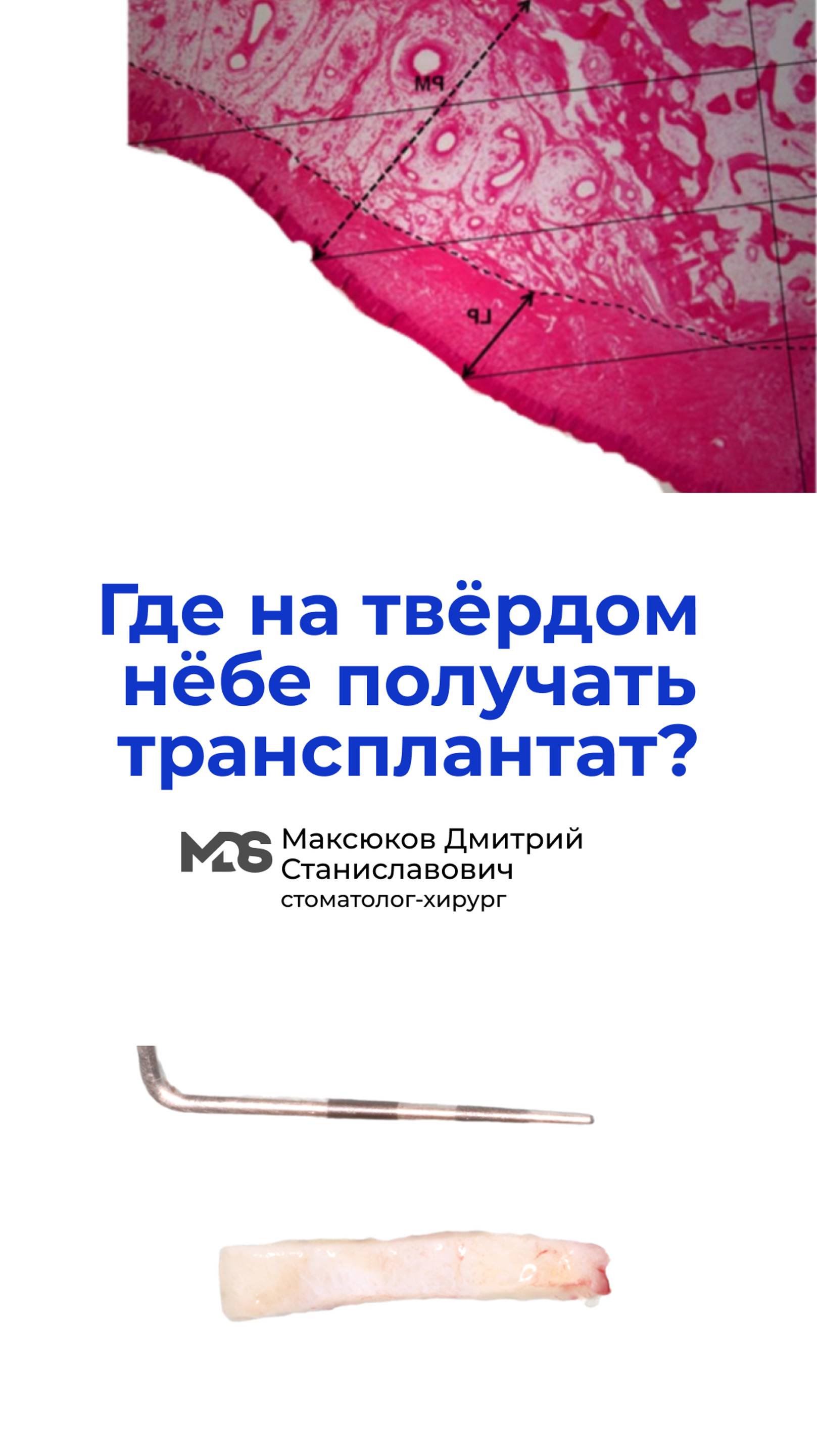 Где на твердом нёбе получать трансплантат ? Ближе к маргинальному краю или посередине?