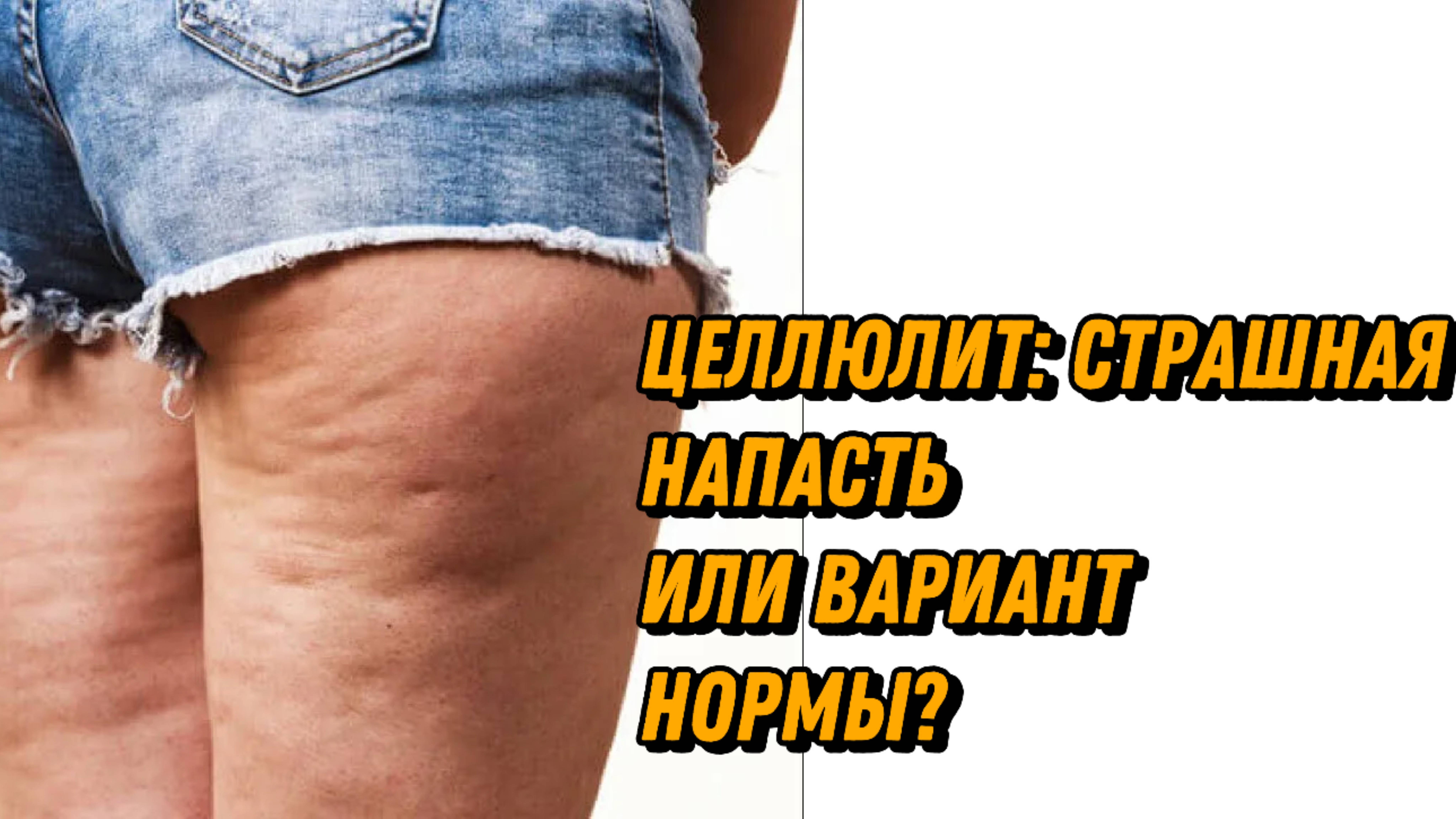 ⚠️ ЦЕЛЛЮЛИТ: СТРАШНАЯ НАПАСТЬ ИЛИ ВАРИАНТ НОРМЫ?