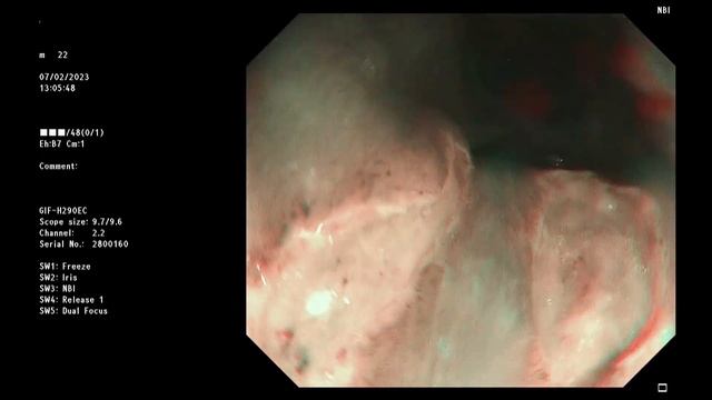 Herpes Simplex Ulcerative Esophagitis