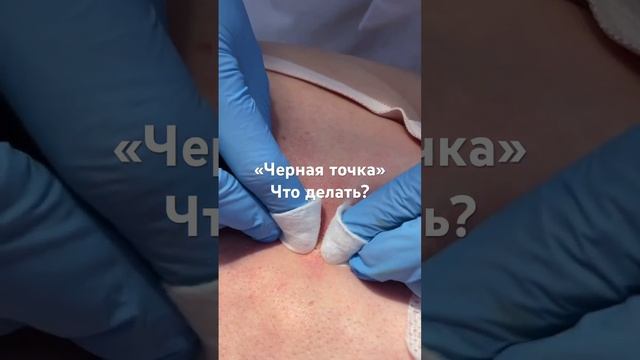 Черные точки. Что делать?