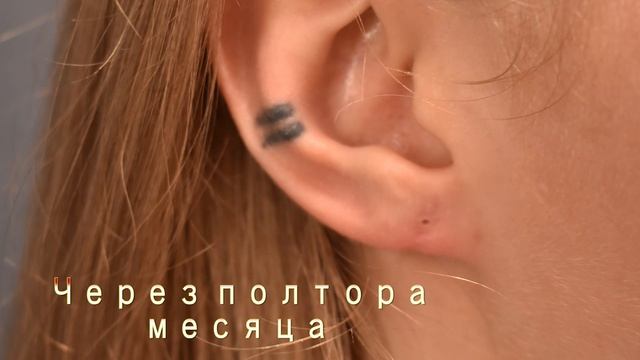 Зашивание тоннелей  и реконструкция мочки