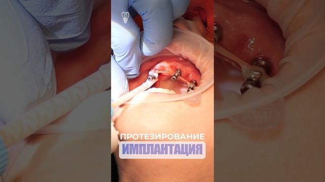 Протезирование. Prosthetics. Implantation.