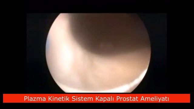 Plazma Kinetik Sistem Kapalı Prostat Ameliyatı - Üroloji Uzmanı Prof.Dr. Ayhan Karaköse