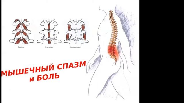 Здоровый позвоночник. Спину прихватило.