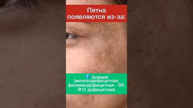 Из-за чего появляется пигментация? #shorts #пигментация #диетолог #рецепты