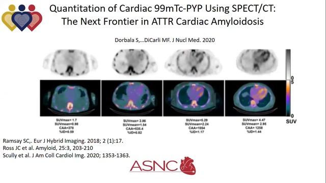 Cardiac Amyloidosis in Latin America: Read with the Experts