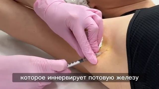 Лечение гипергидроза в косметологии DuoClinic