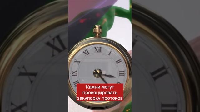 Стадии формирования желчных камней