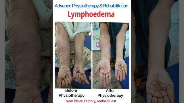 Lympoedema: Lymphatic Drainage Dr Hemal K Sanghavi (PT) 8446993833