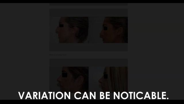 Rhinoplasty | Dr. Zewert M.D., PH.D.