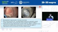Эндоскопическая диссекция гигантского полипа желудка у ребенка с синдромом Пейтца-Егерса