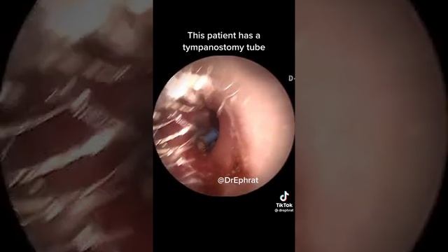 so patient in earwax