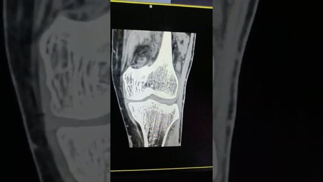 CoRonal section of knee joint