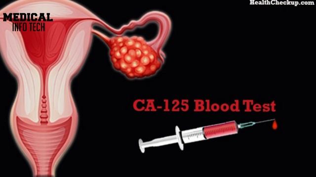 CA 125 Test