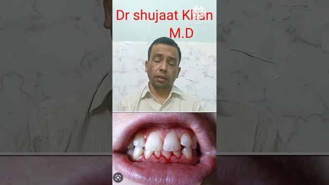Scurvy, Causes And Treatment ( Vitamin C Deficiency)