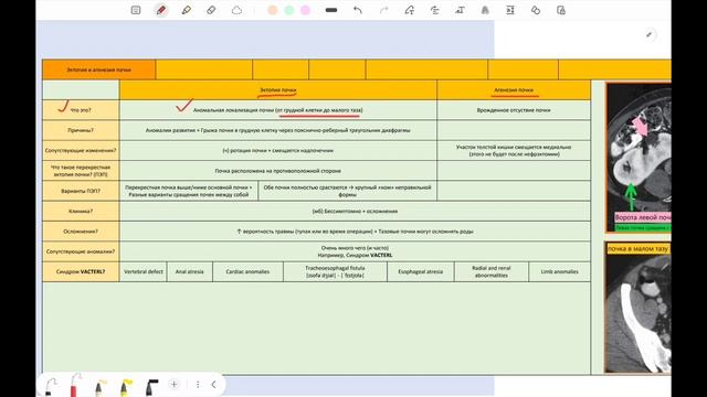 Бертиниевы колонны, фетальная долчатость почки, эктопия и агенезия почки
