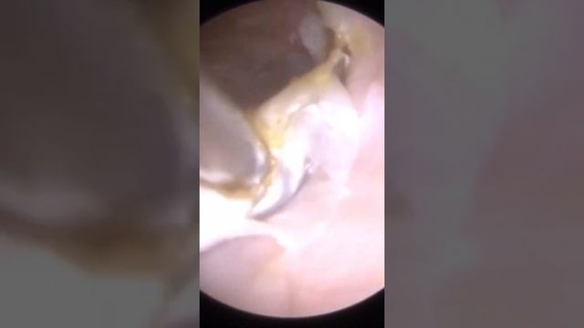 Cotton Wool Ball Ear Wax Removal1080P HD EP1