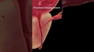 Attention! Prostate Enlargement Symptoms #prostateproblems #usa