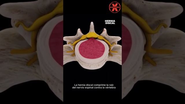 Hernias Discales Lumbares